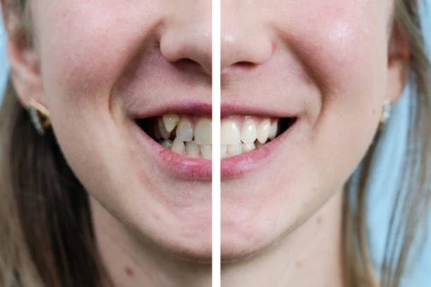 😁 Crossbite Solutions: Do Retainers Work?