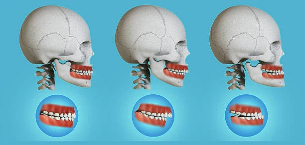 😬 Bite Problems: Can Retainers Fix Them?