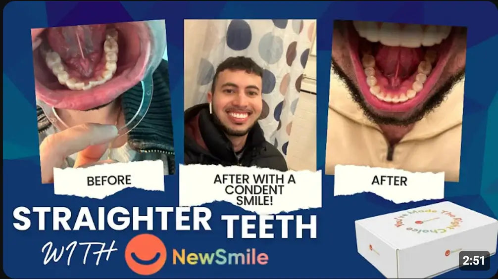 I Fixed My Teeth With NewSmile Invisible Aligners | Customer Honest Review